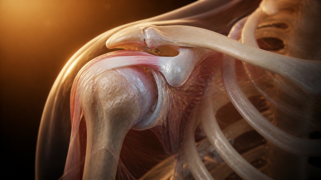 joint space narrowing on x-ray